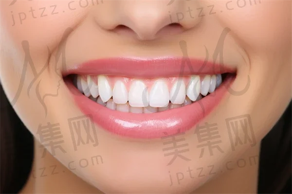 牙齿美白贴片的结果如何？真的能让牙齿变得更白吗？