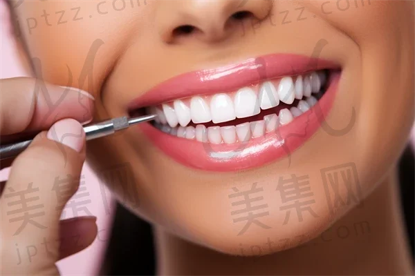 桂林牙齿美白费用是多少？2025年牙齿美白价格表重磅发布，皓齿美白价格也在其中！