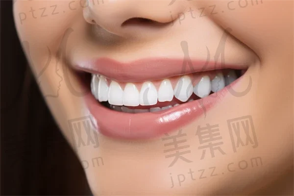 岳阳牙齿美白费用是多少？2025年牙齿美白价格齐全解析，同时简要介绍四环素牙的相关费用。
