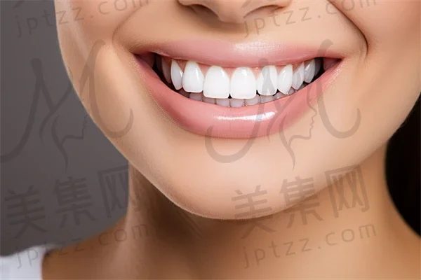 牙齿美白通常使用哪些材料？了解不同材料的结果与选择技巧